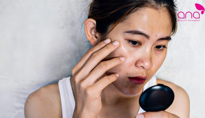 Tình trạng da tối màu và kém đều màu